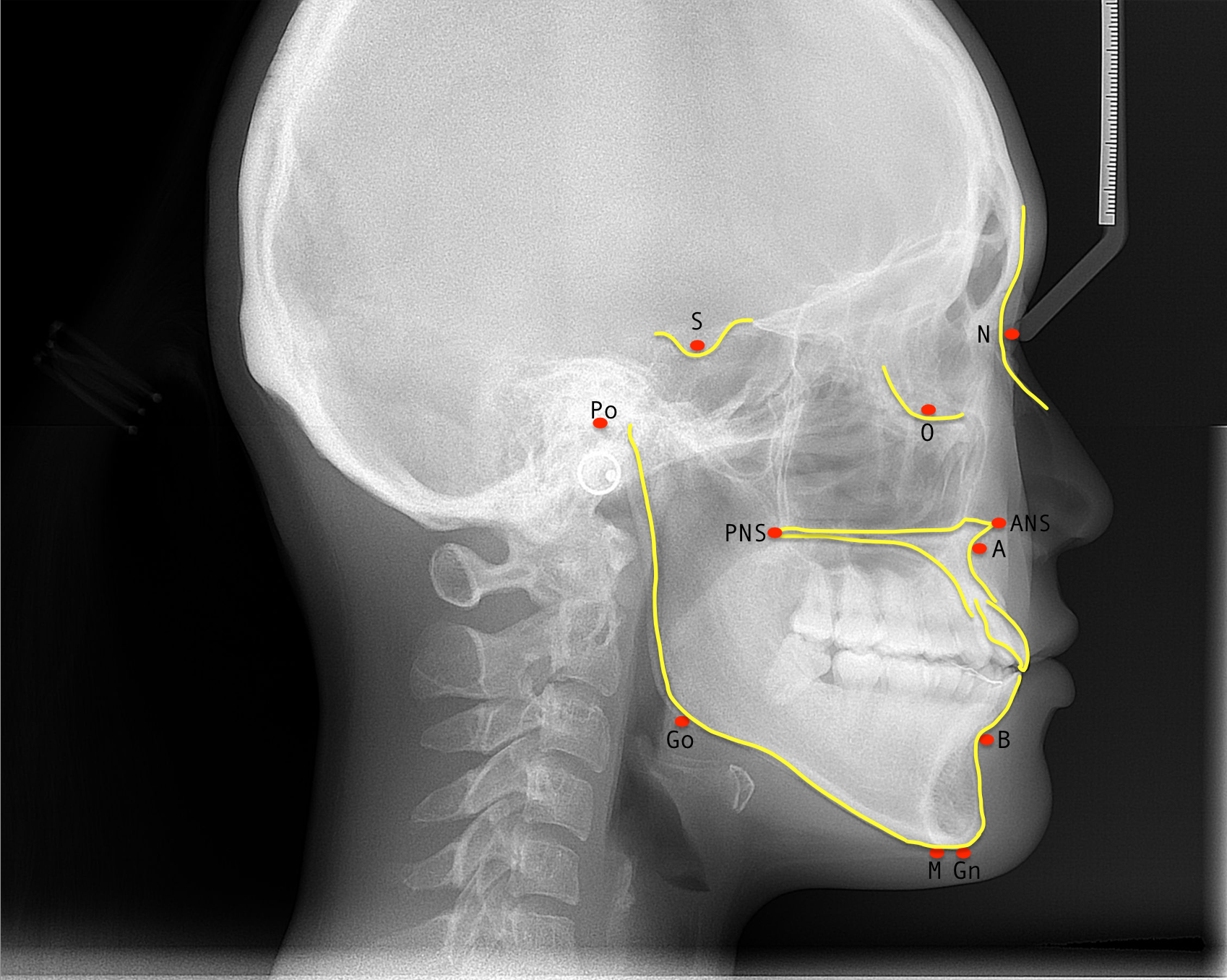 Common cephalometric points.