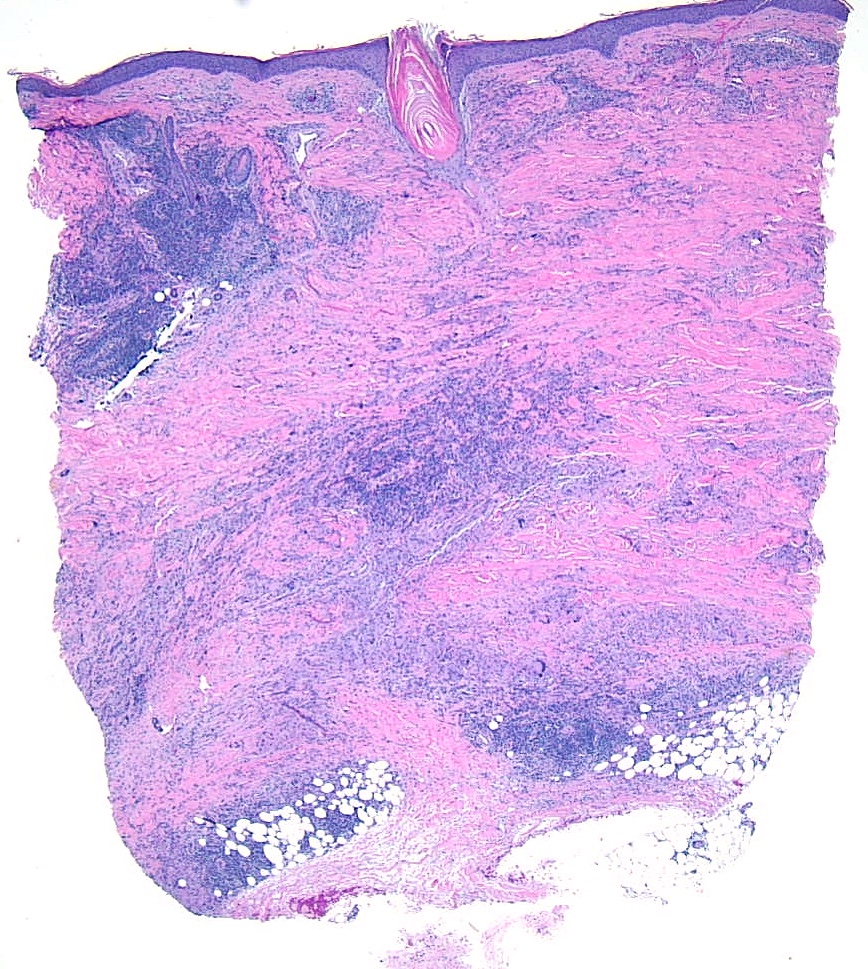 <p>Low-Power Pathological Findings of Necrobiosis Lipoidica: Skin Biopsy