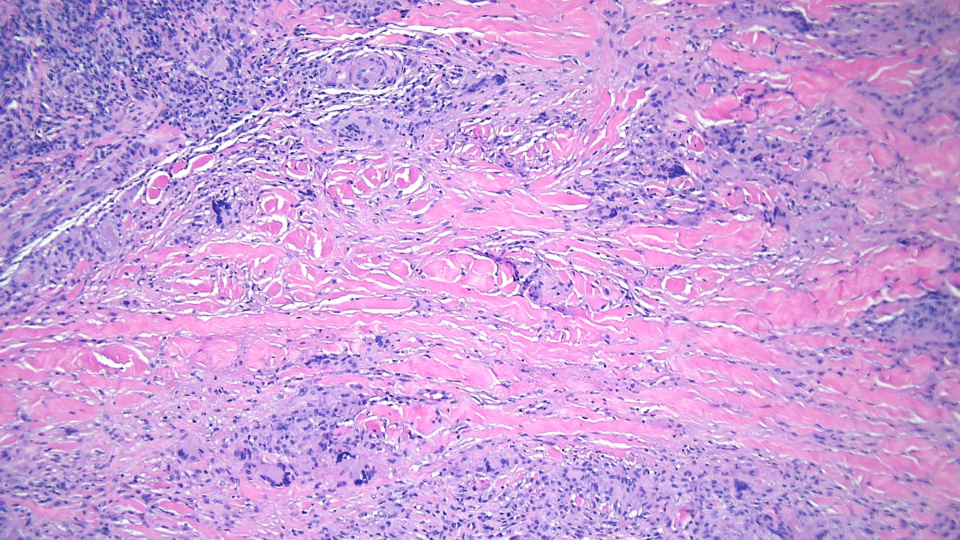 <p>High-Power Pathological Findings of Necrobiosis Lipoidica: Skin Biopsy