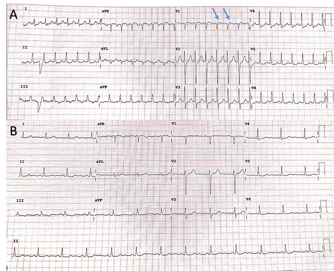 <p>Narrow Complex Tachycardia versus Sinus Rhythm: Pseudo R Waves