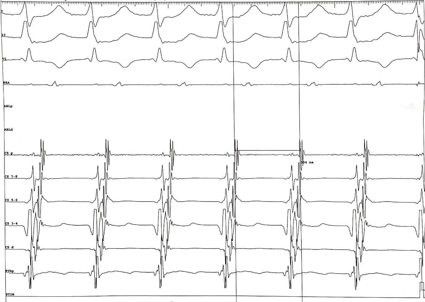 <p>Orthodromic AVRT: Long Ventriculoatrial Interval