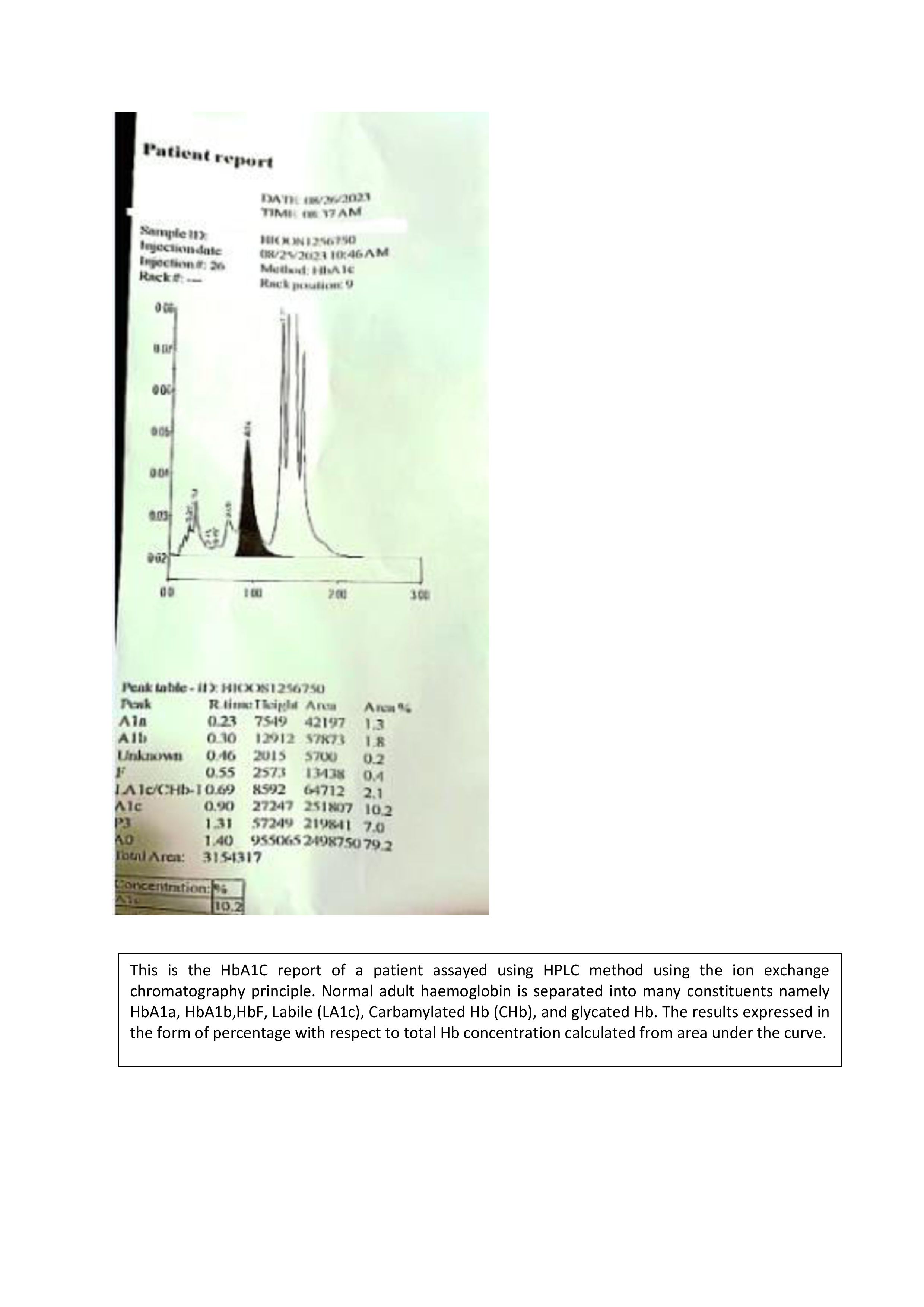 HPLC based separation of Hemoglobin