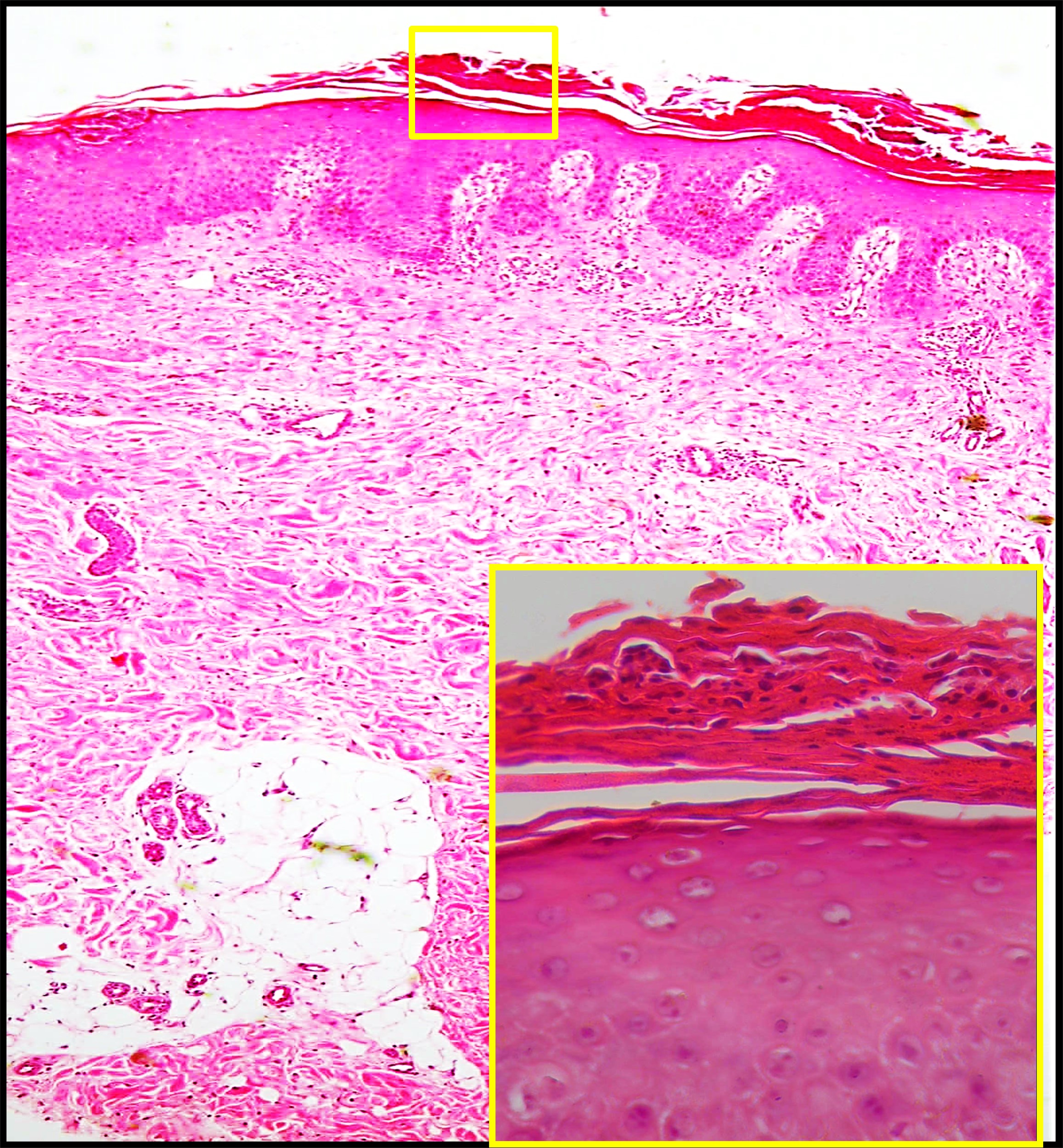 <p>Histopathology of Pustular Psoriasis