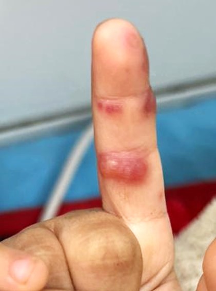 <p>Blistering Dactylitis. Multiple bullae over the index finger.</p>