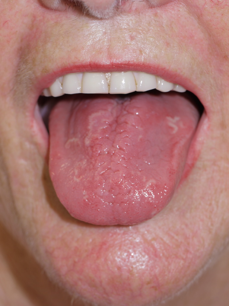 <p>Geographic Tongue</p>