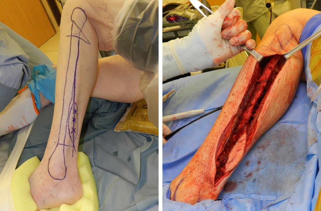 <p>Preoperative Fibula Markings and Exposed Fibula