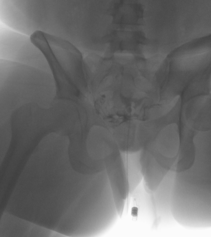 <p>Patent Fallopian Tubes. A hysterosalpingogram demonstrating bilateral fallopian tube patency.</p>