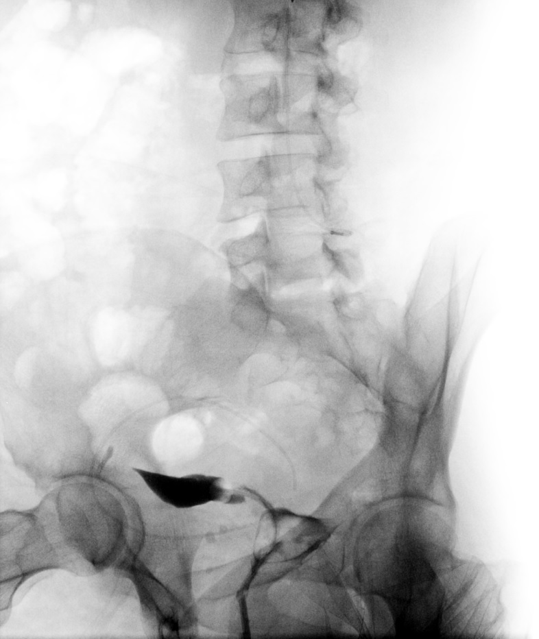 <p>Bilateral Fallopian Tube Occlusion