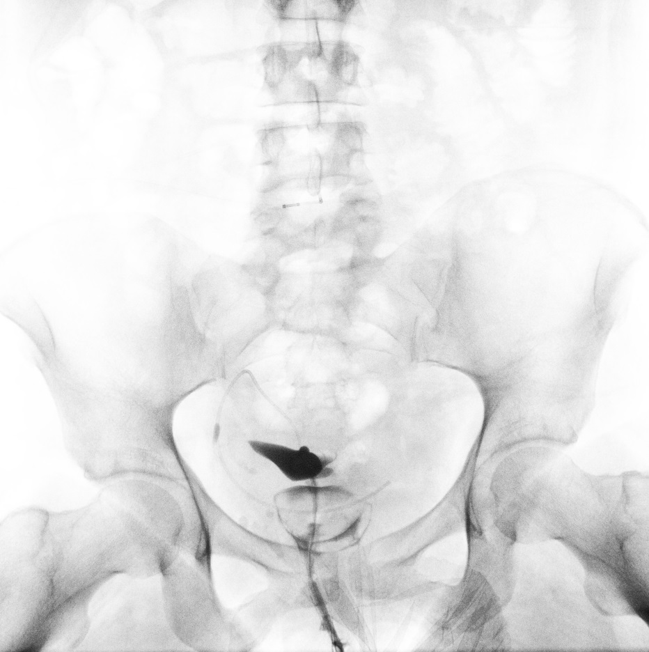 <p>Endometrial Cavity Image on Hysterosalpingogram