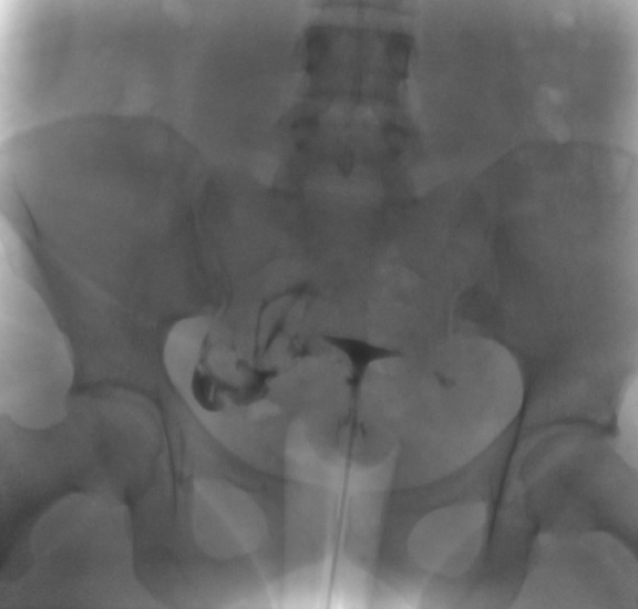 <p>Left Fallopian Tube Occlusion