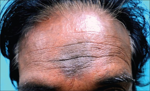 <p>Kumkum-Induced Pigmented Contact Dermatitis