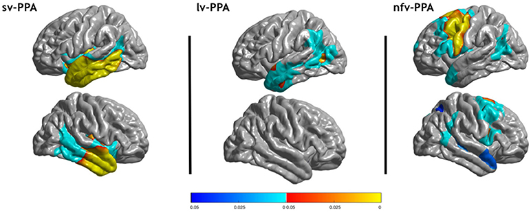 <p>Primary Progressive Aphasia Variants