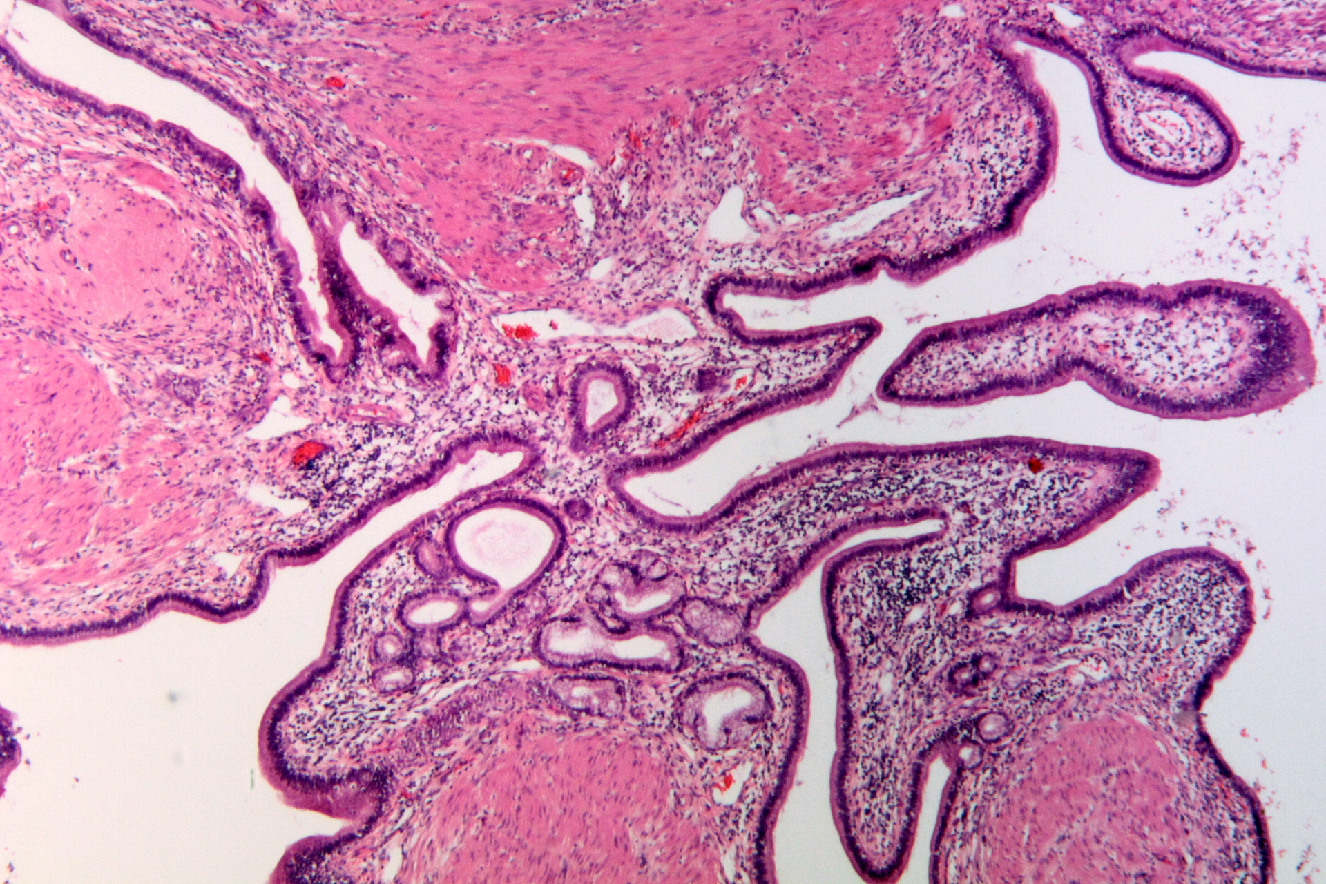 <p>Gallbladder Adenomyomatosis