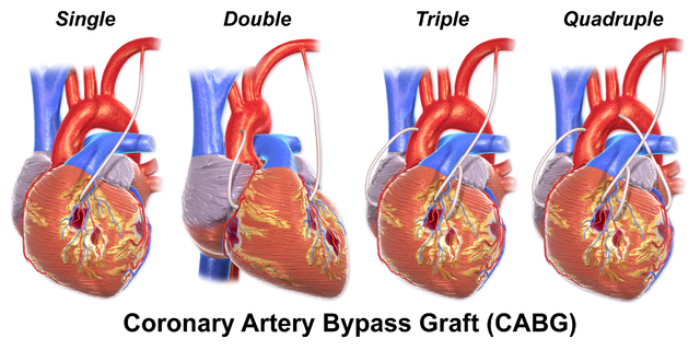 <p>Coronary Artery Bypass Graft