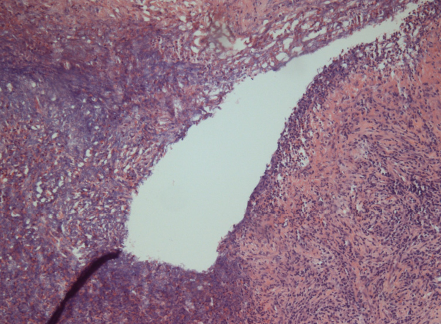 <p>Chronic Lung Abscess</p>