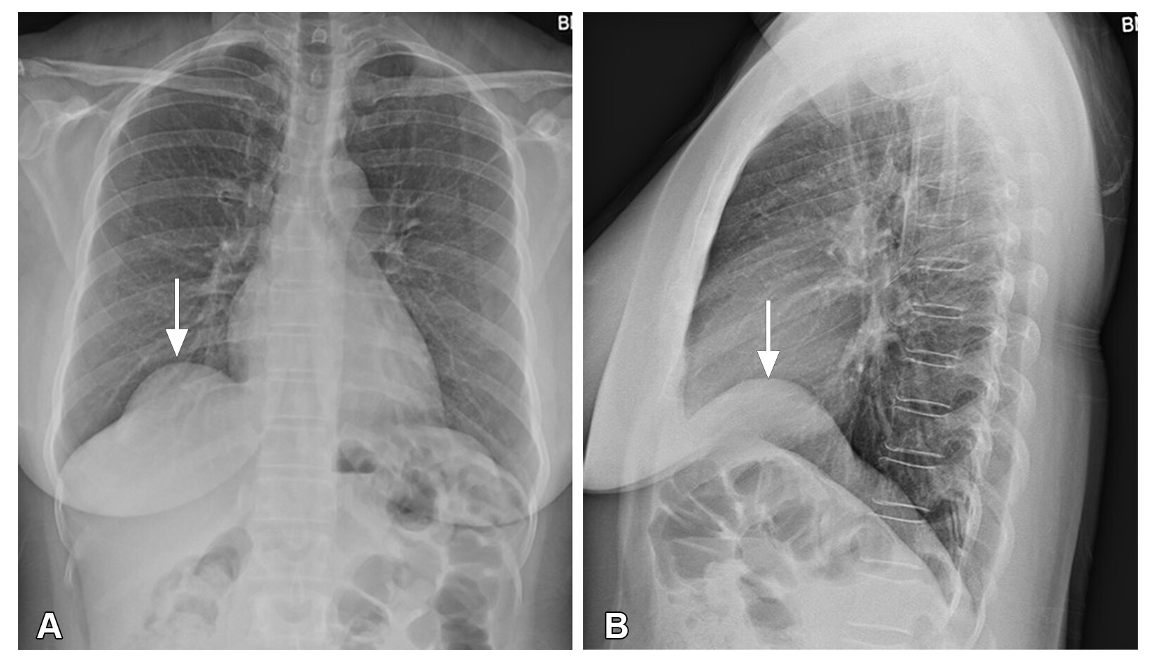 <p>Diaphragm Eventration