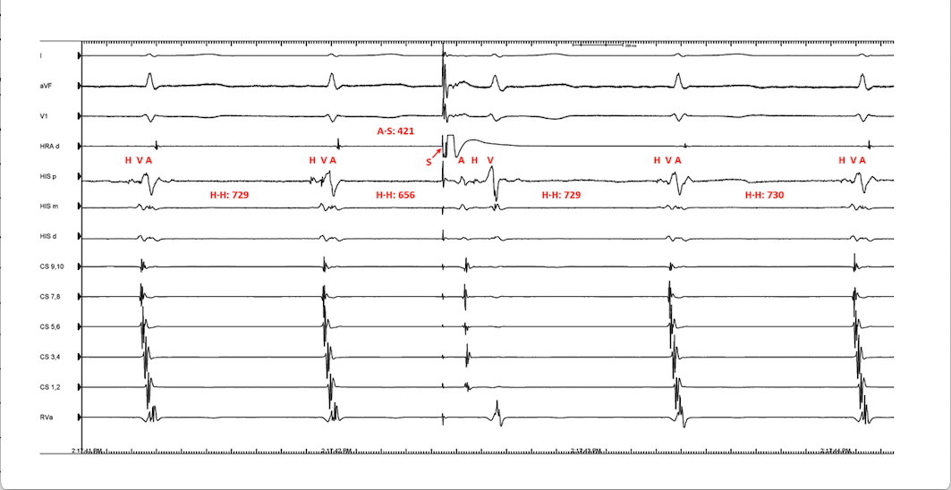 <p>Response to Early Premature Atrial Contraction in Junctional Tachycardia vs Atrioventricular Nodal Reentrant Tachycardia