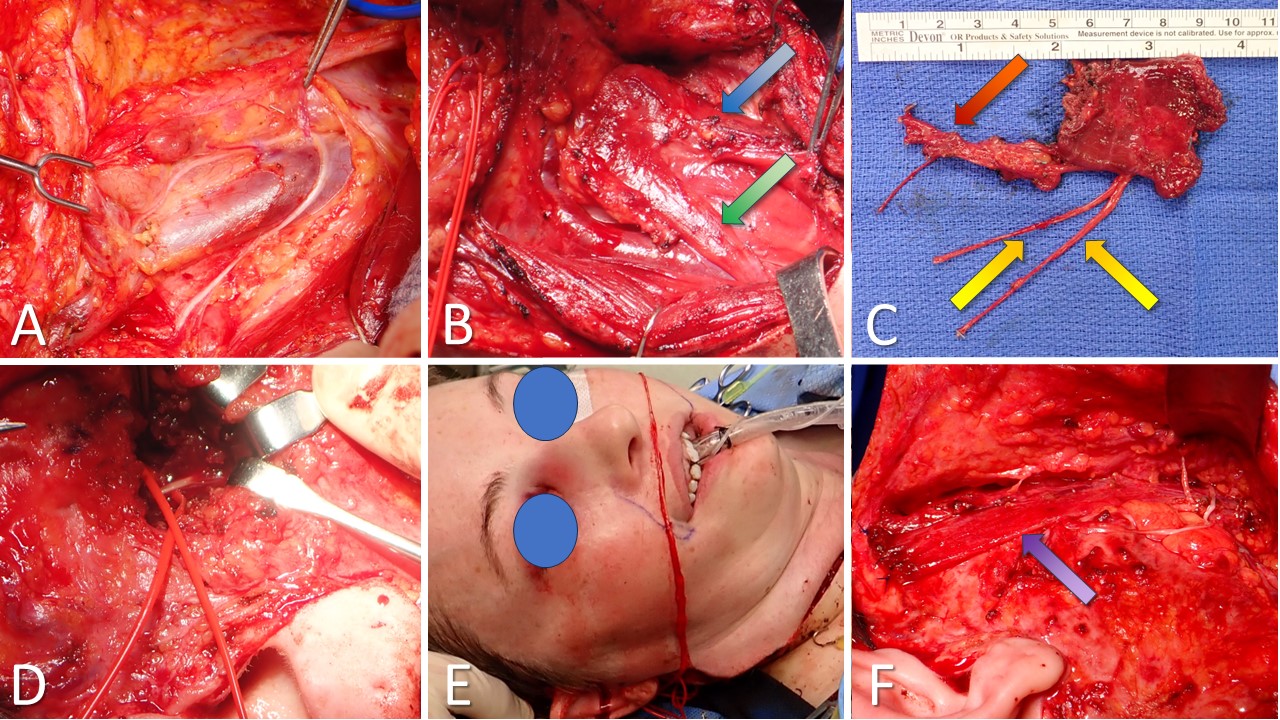 <p>Sterno-Omohyoid Flap for Facial Reanimation