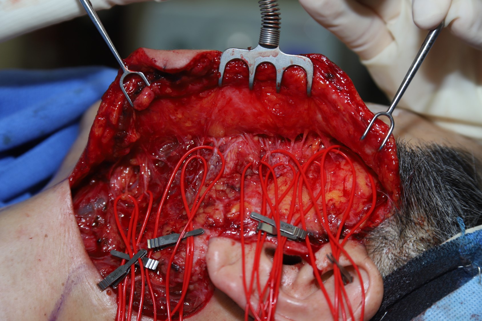 <p>Selective Neurectomy for Facial Synkinesis