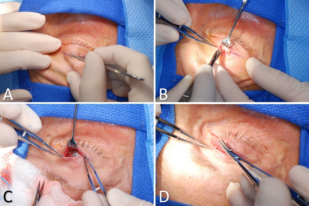 <p>Pretarsal Upper Eyelid Weight Placement