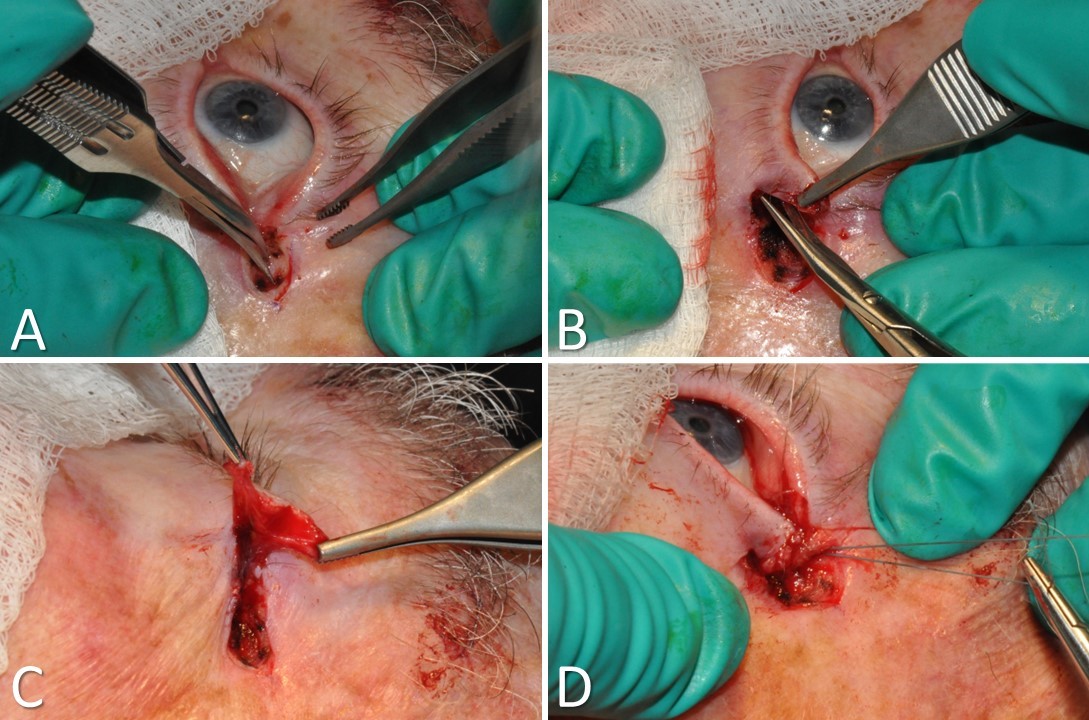 <p>Tarsal Strip-Lateral Canthopexy