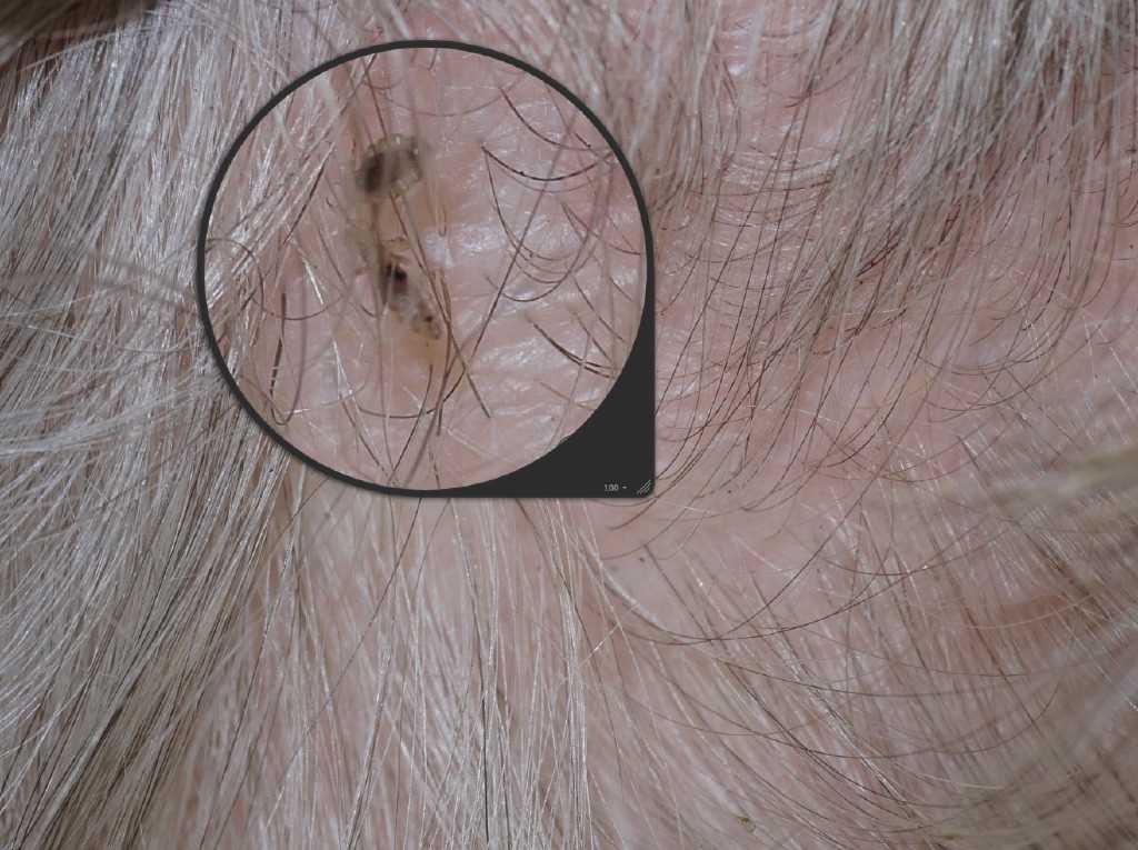 <p>Head Lice</p>