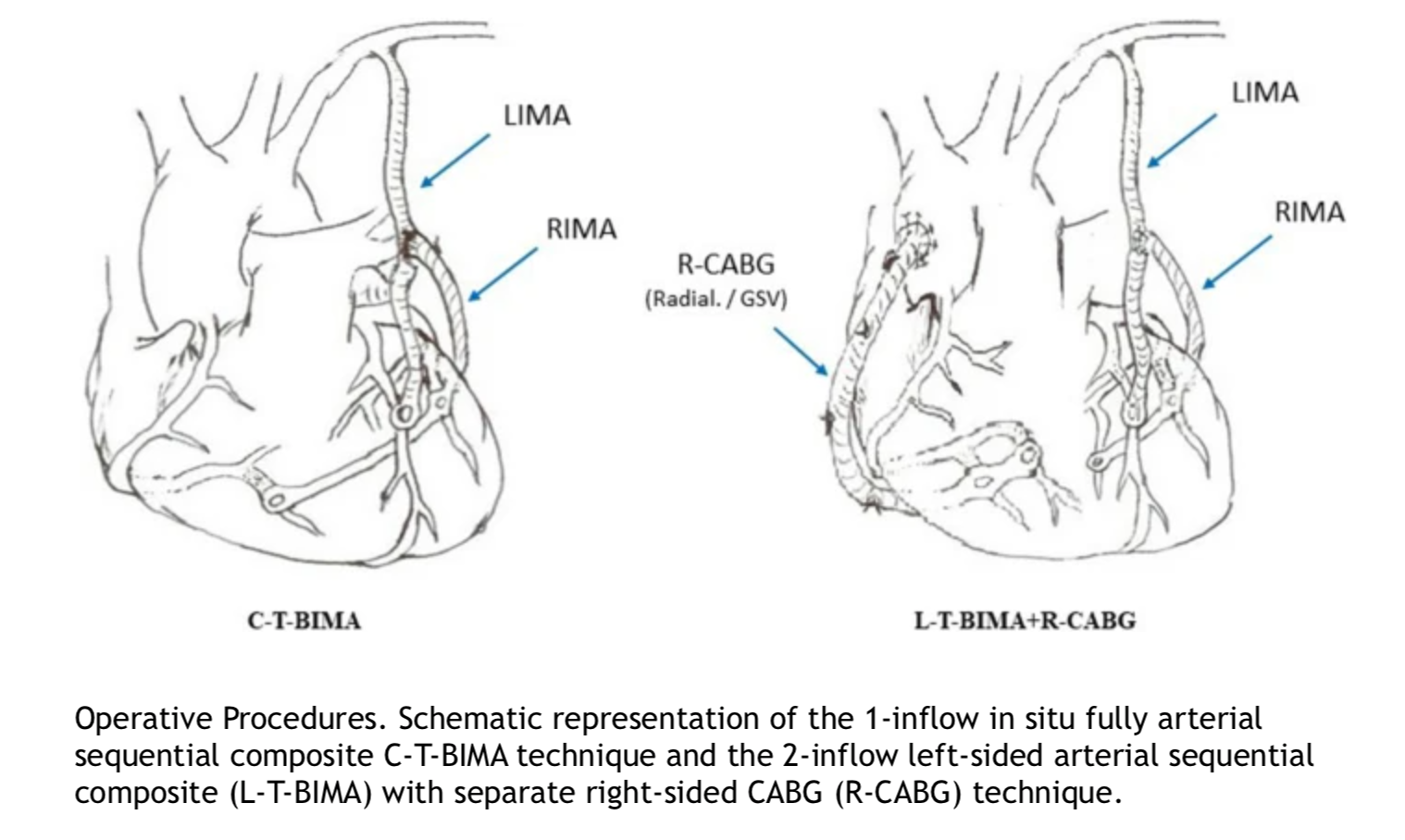 <p>Coronary Revascularization Procedures