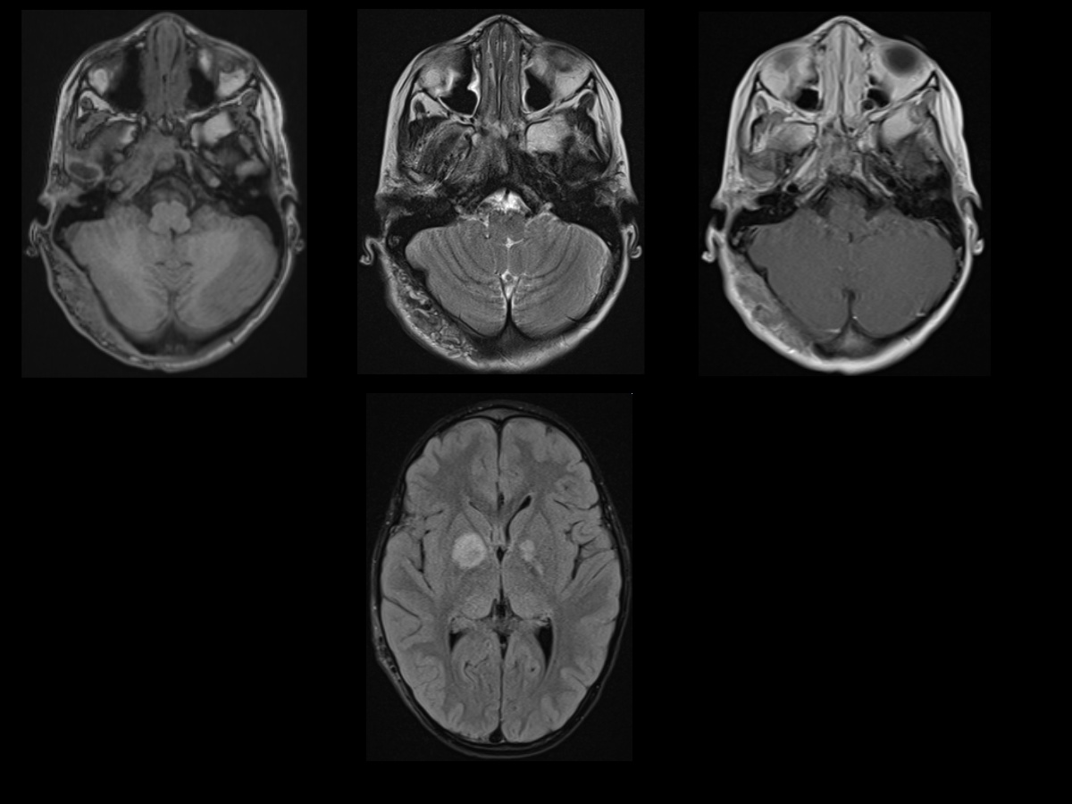 <p>Neurofibromatosis Type I MRI