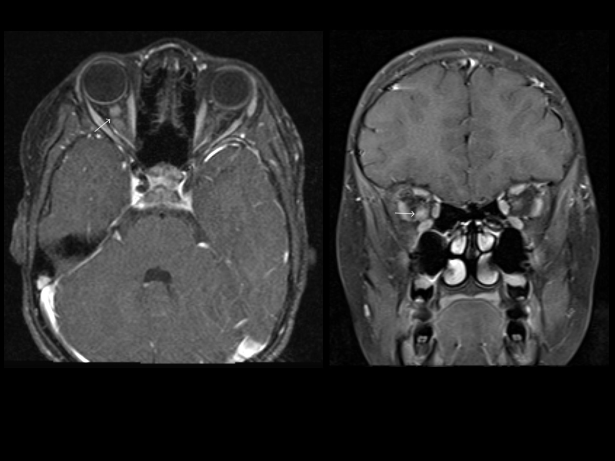 <p>Optic Nerve Glioma
