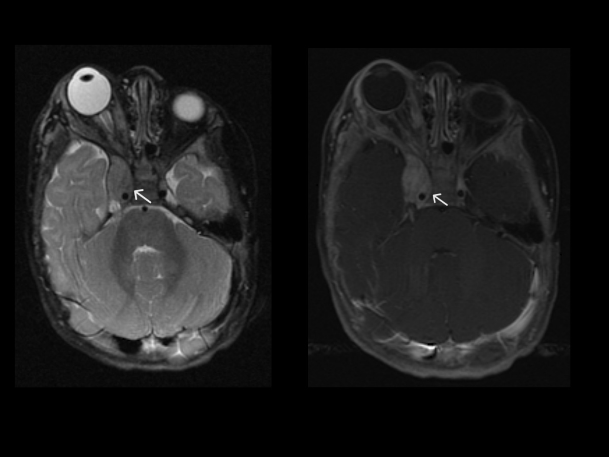 <p>Plexiform Neurofibroma