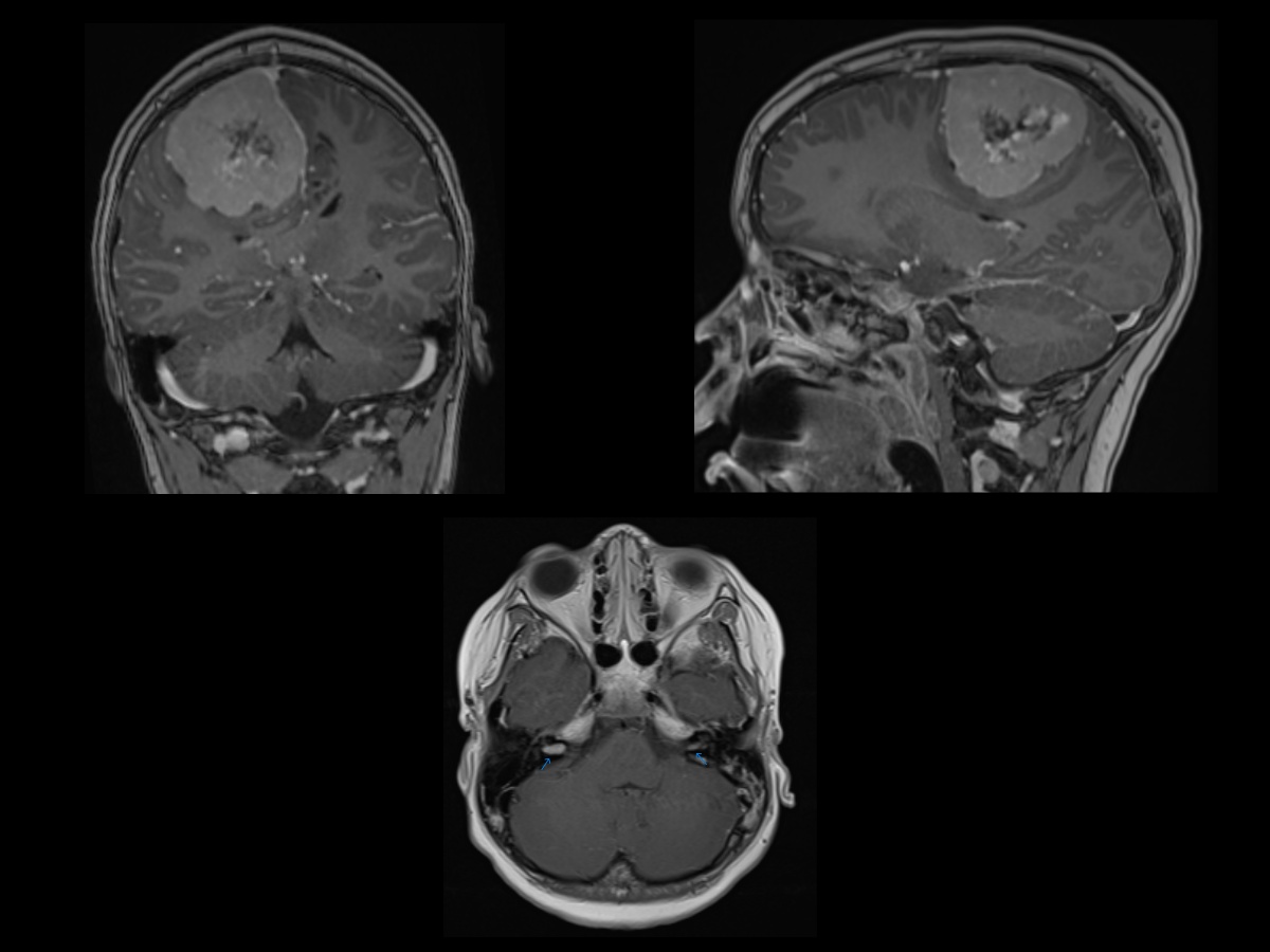 <p>Bilateral Vestibular Schwannomas