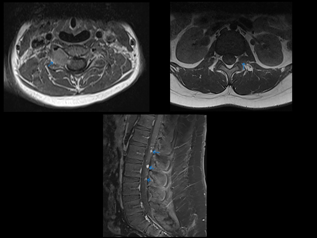 <p>Neurofibromatosis Type 2 MRI