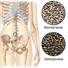 <p>Normal Versus Osteoporotic Bone