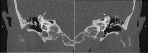 <p>Computed Tomography of Temporal Bones
