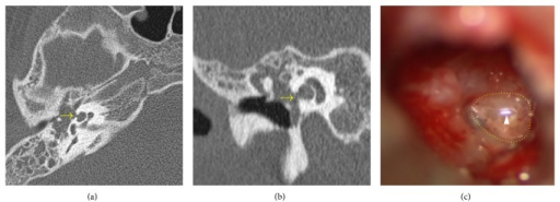 <p>Cholesteatoma CT