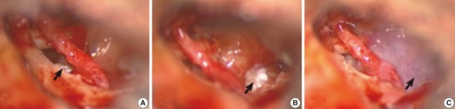 <p>Standard Surgical Techniques of Perilymph Fistulas Repair