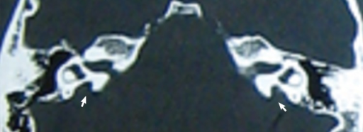 <p>Enlarged Vestibular Aqueduct