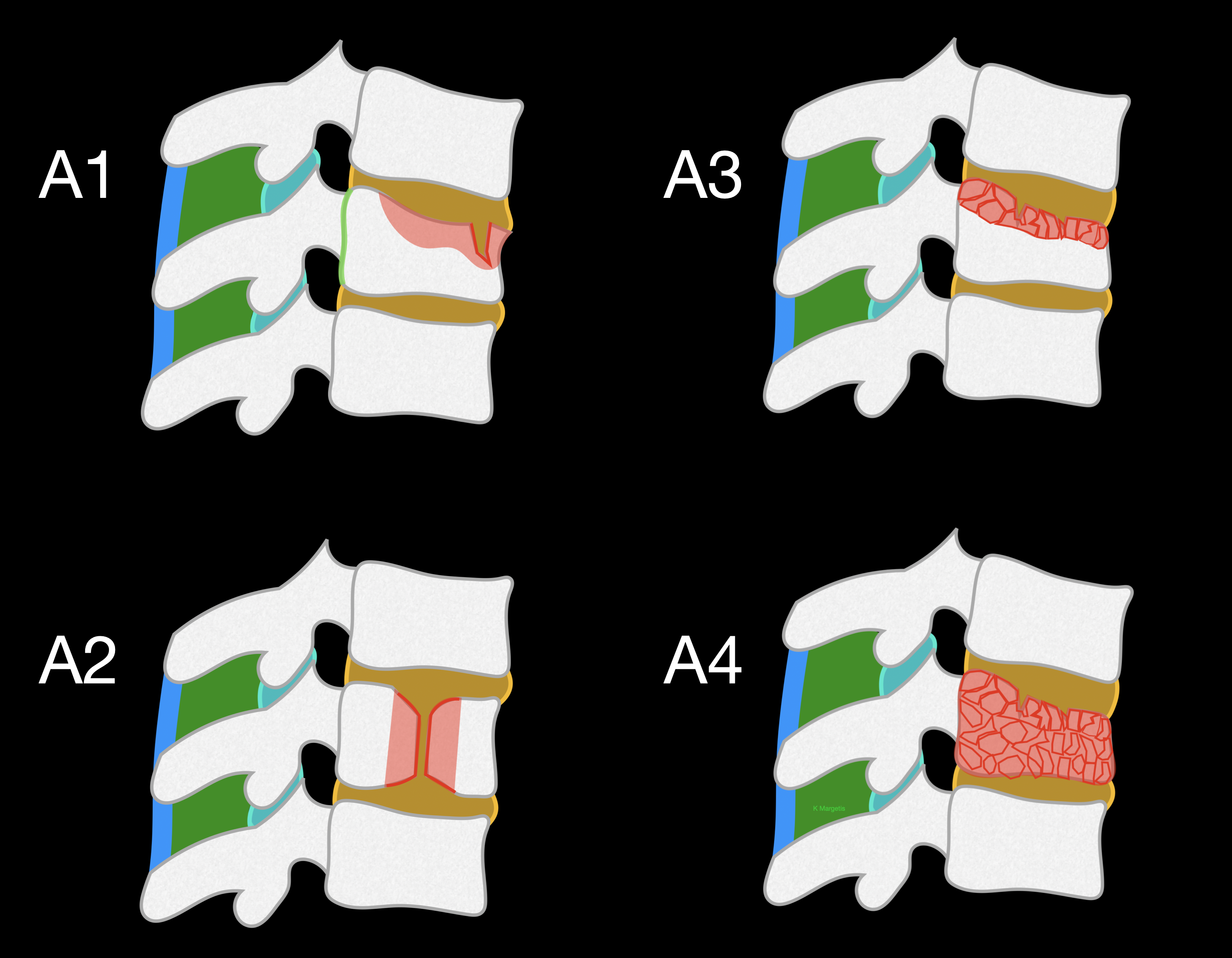 <p>AO Spine Thoracolumbar Spine Injury Classification