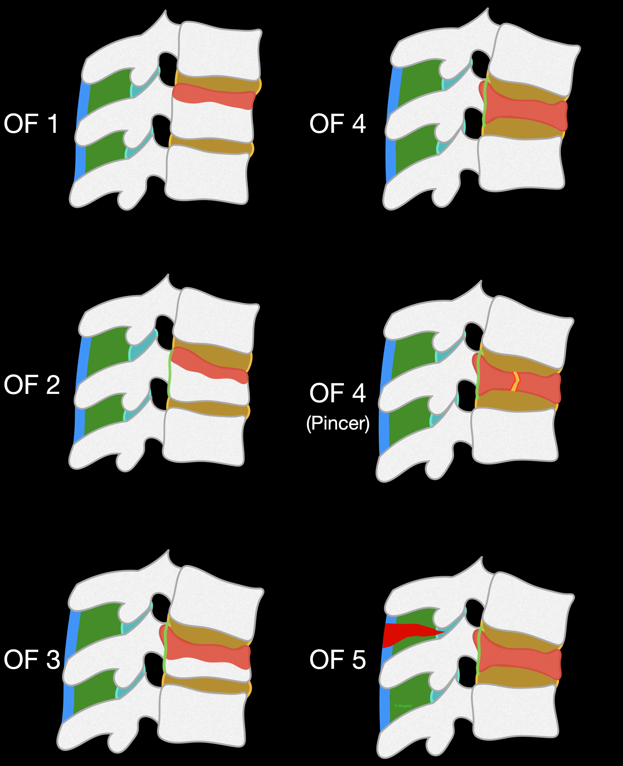 <p>Osteoporotic Fracture Classification System