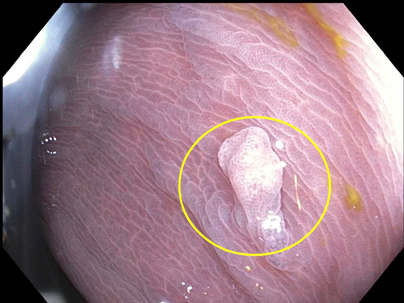 <p>Colon Polyp