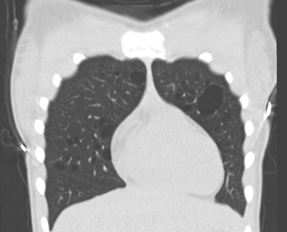 <p>Tuberous Sclerosis, Chest Computed Tomography (CT)