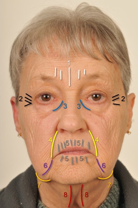 <p>Stigmata of the Aging Face
