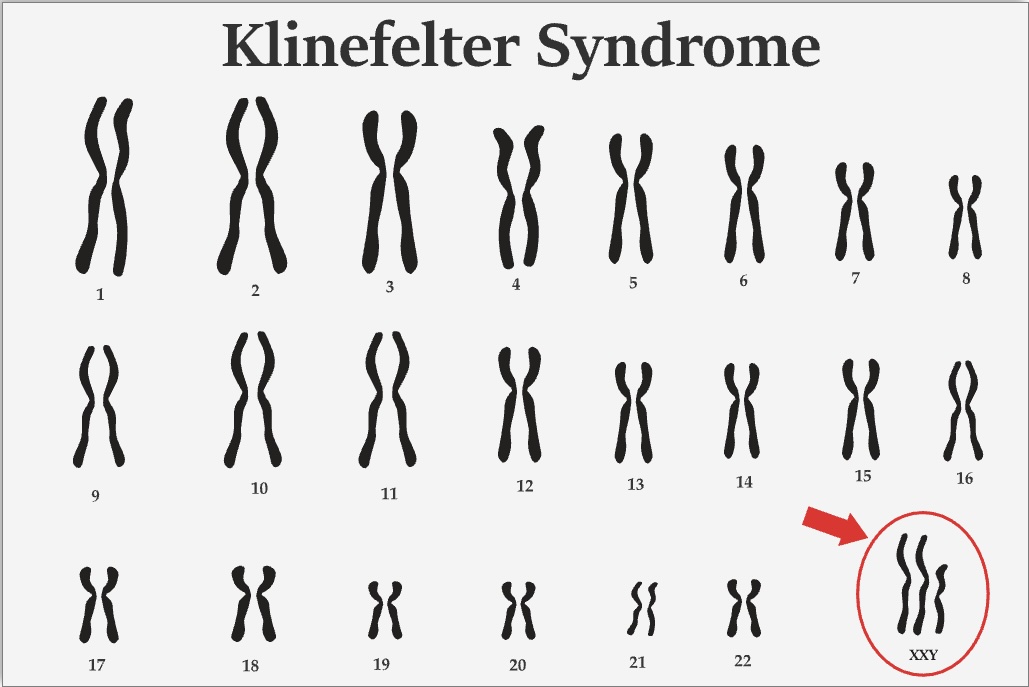 <p>Klinefelter Syndrome&nbsp;Karyotype