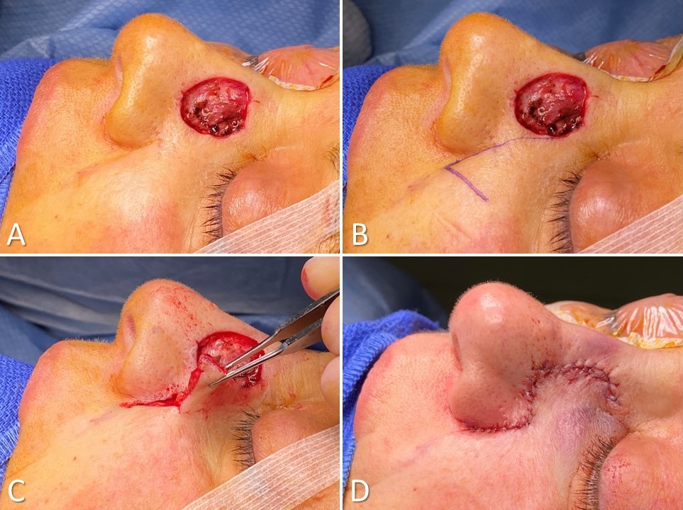 <p>Melolabial Note Flap for Nasal Sidewall Reconstruction