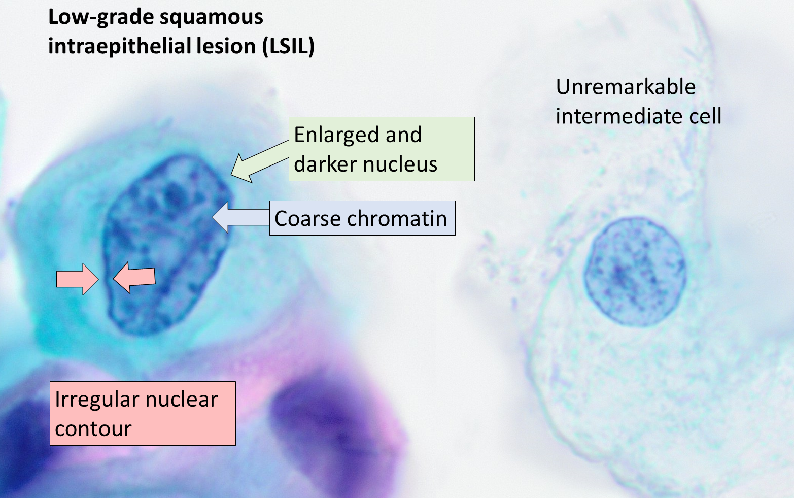 <p>Low-Grade Squamous Intraepithelial Lesion Pap With Features of Koilocytosis Compared to Unremarkable Intermediate Squamous Cell