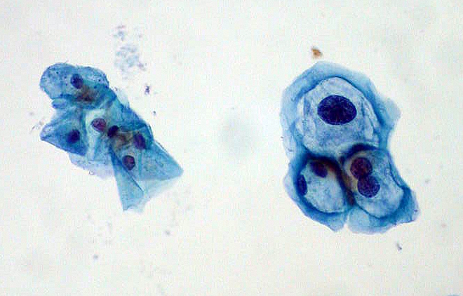 <p>Squamous Epithelial Cells With and Without Koilocytosis.</p>
