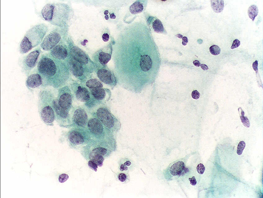 <p>Pap With Endocervical Cells.</p>