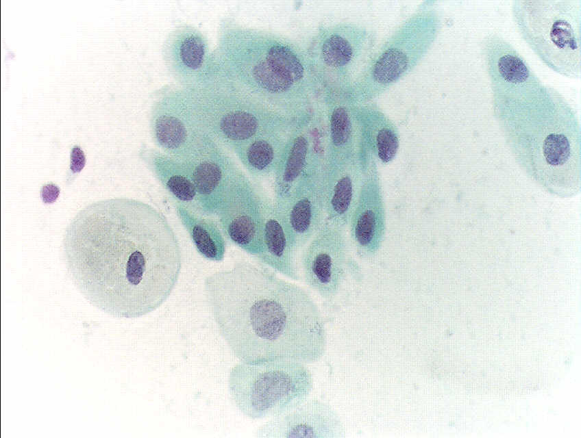 <p>Pap With Atrophic Squamous Cells.</p>