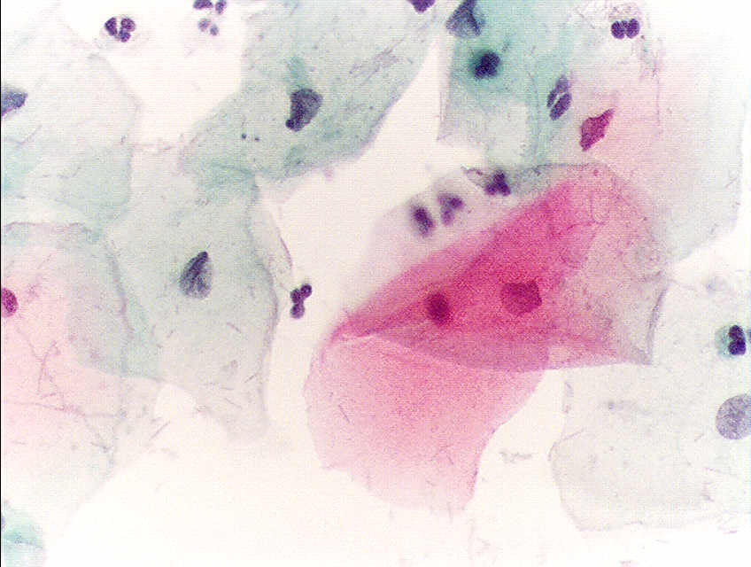 <p>Pap With Negative for Intraepithelial Lesion or Malignancy