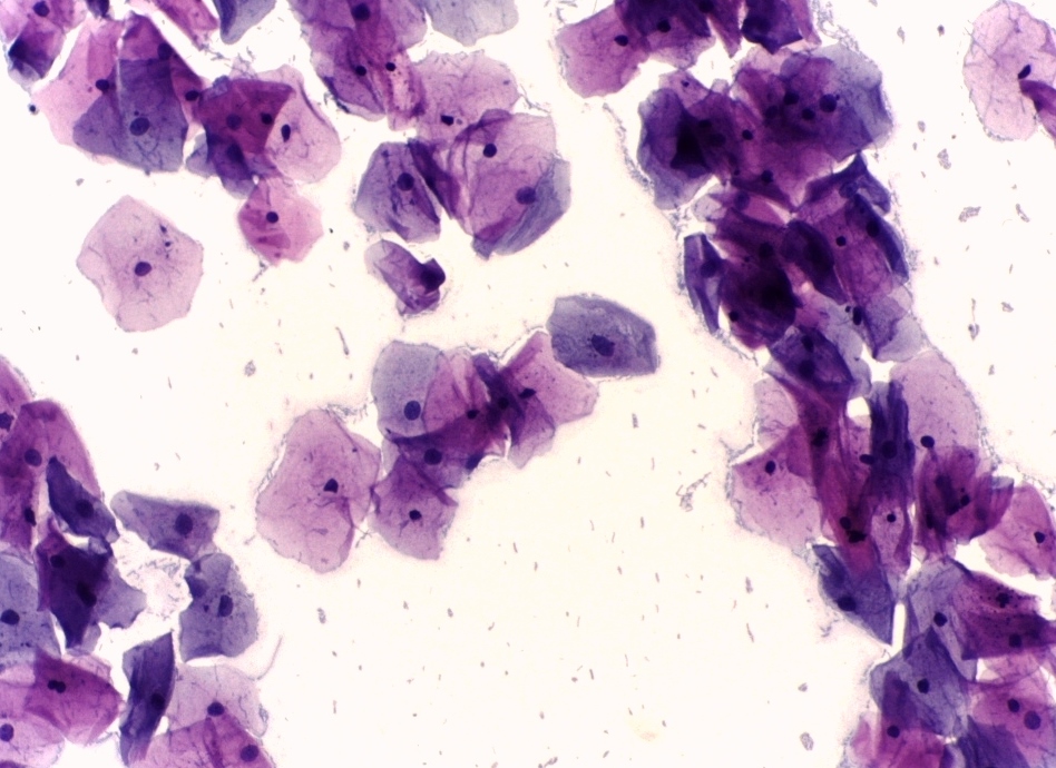 <p>Second Pap With Negative for Intraepithelial Lesion or Malignancy.</p>